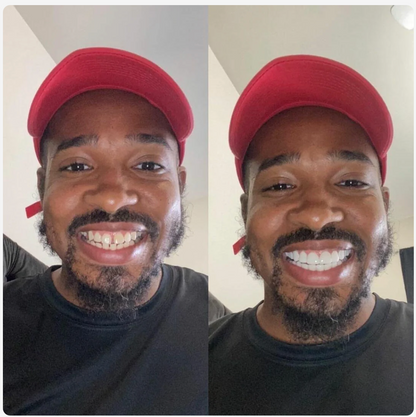 Adjustable Snap-on Dentures