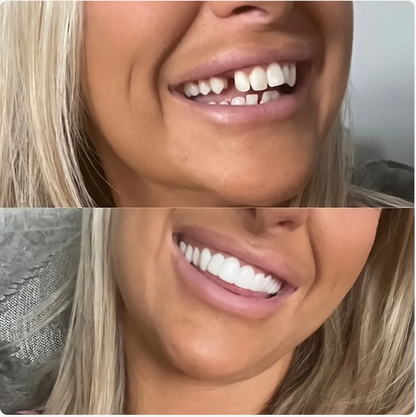 Adjustable Snap-on Dentures