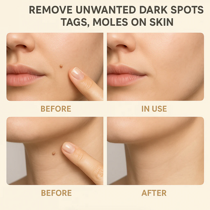 Lanbena™️Organic Skin Tag Remover Serum | All Natural For Warts